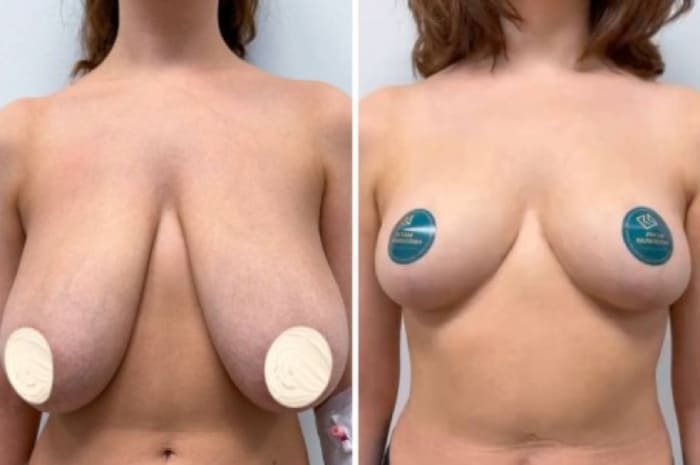 Редукционная маммопластика. До и после. Вид спереди