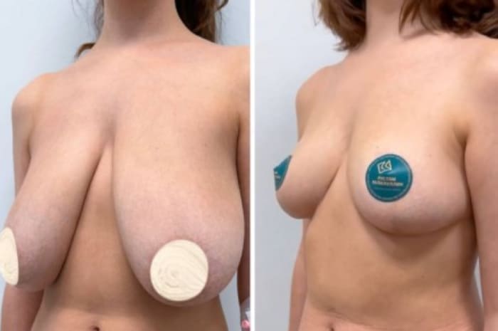 Редукционная маммопластика. До и после. Вид сбоку