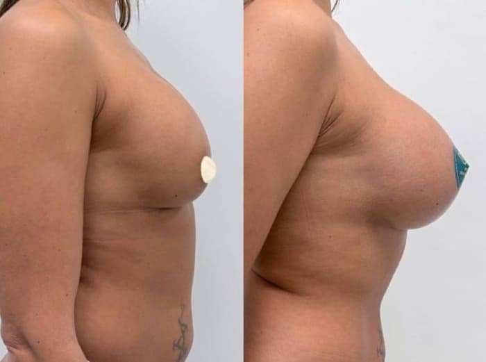 До и после. Реэндопротезирование. Вид сбоку