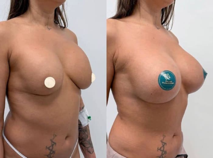 Реэндопротезирование. Хирург Халилуллин Р.И.