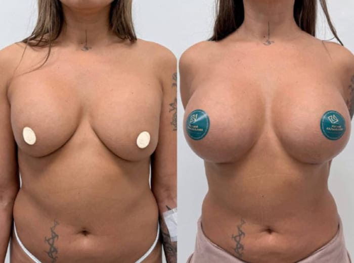 До и после. Реэндопротезирование. Вид спереди