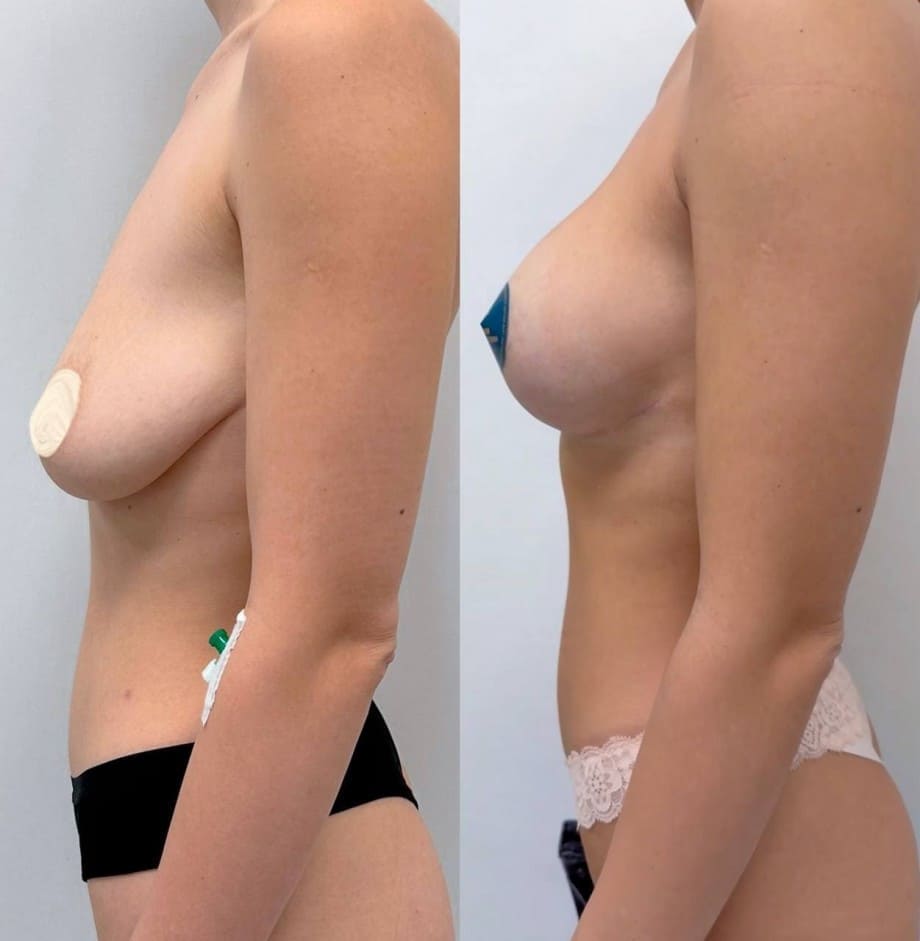 Якорная подтяжка. Хирург Халилуллин Р.И.