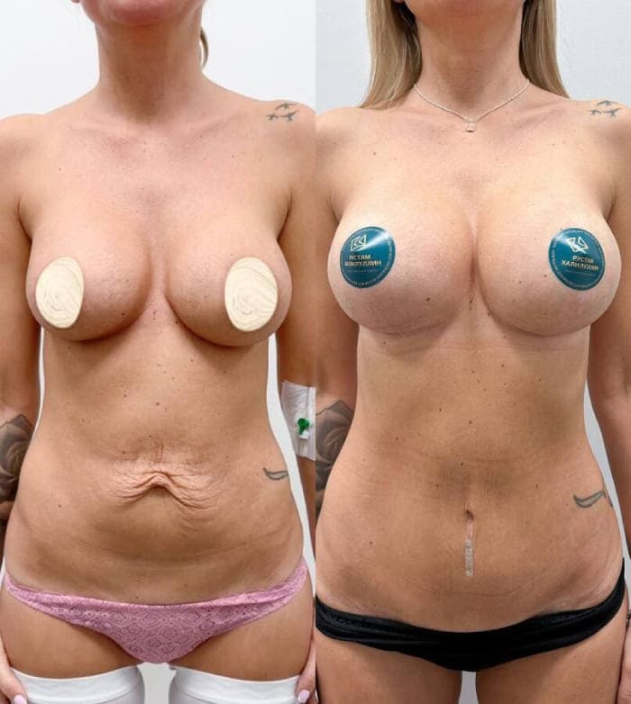 Реэндопротезирование и абдоминопластика. Хирург ХалилуллинР.И.