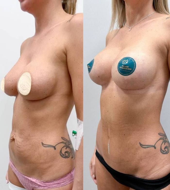 Липоабдоминопластика с реэндопротезированием. Халилуллин Р.И.