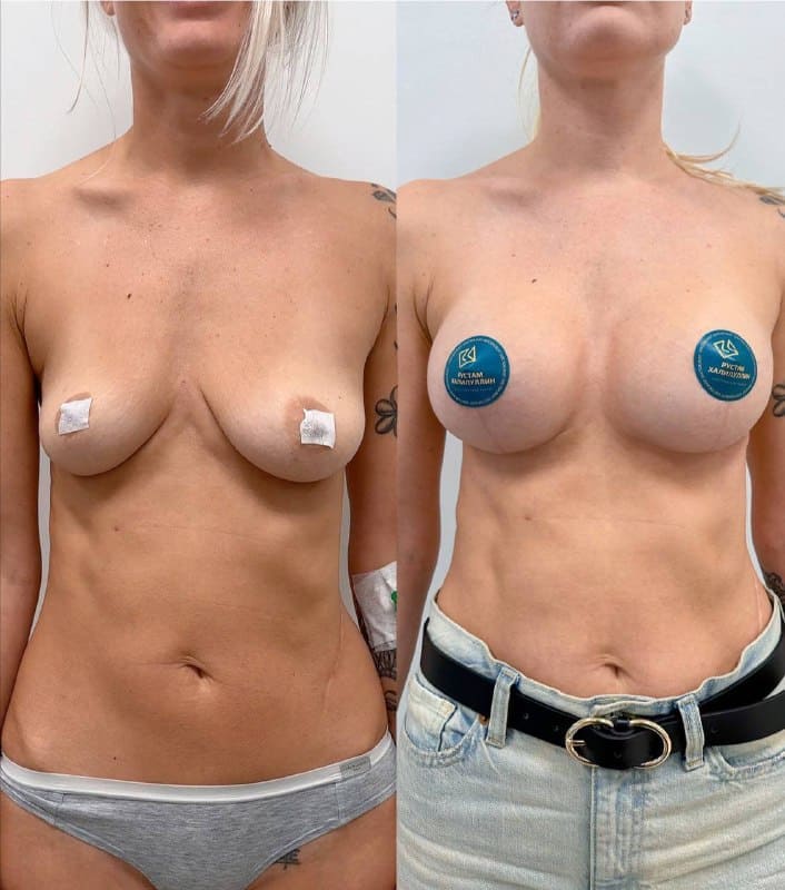 Пример якорной подтяжки груди с имплантацией. Хирург Халилуллин Р.И.