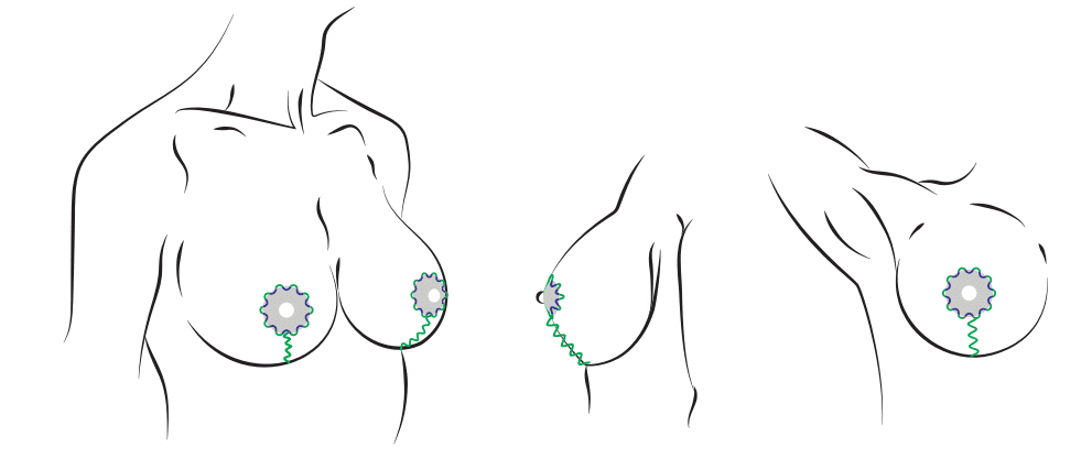 Ареолярно-вертикальная подтяжка груди. Хирург Халилуллин Р.И.
