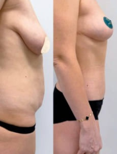 Пример работы хирурга Халилуллина Р.И. Бодилифт, подтяжка груди и феморопластика. Вид сбоку
