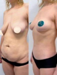 Пример работы Халилуллина Р.И. Бодилифт, подтяжка груди и феморопластика.