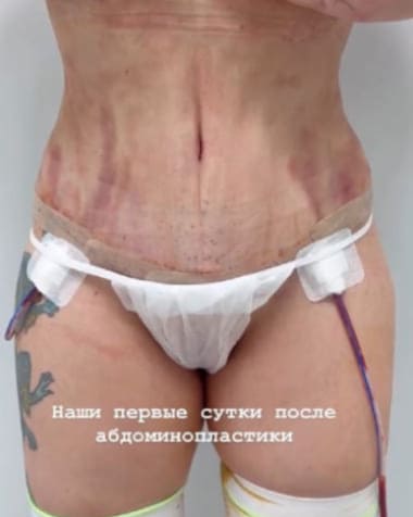 Эпидуральный катетер. Рассказывает пластический хирург Халилуллин Р.И.