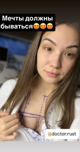 Увеличение груди