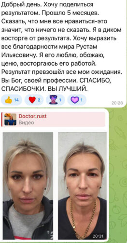 Лобно-височный лифтинг