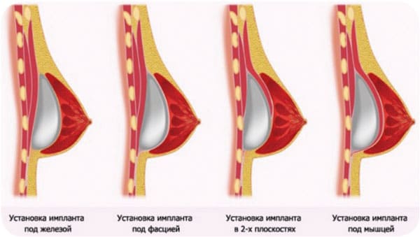 Расположение импланта при маммопластике. Хирург Халилуллин Р.И.