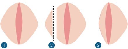 Иллюстрация лабиопластики