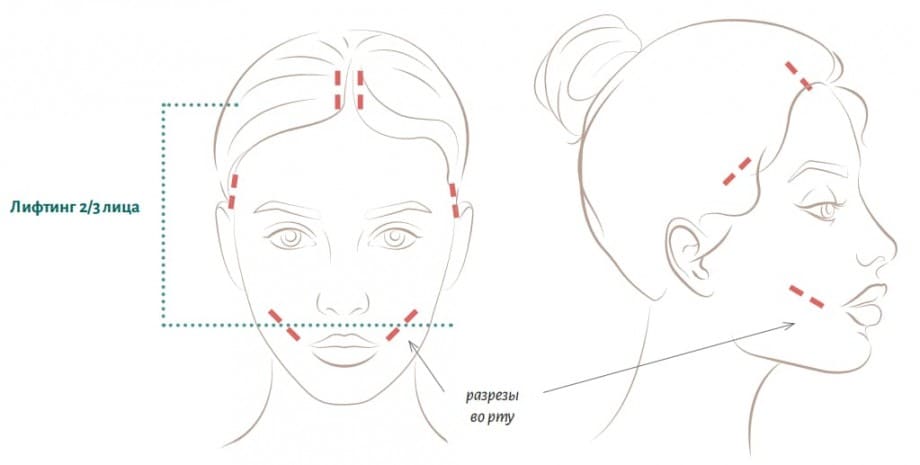 Лифтинг лица - схема разрезов. Хирург Халилуллин Р.И.