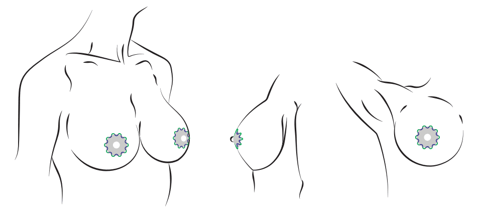Периареолярная подтяжка груди. Хирург Халилуллин Р.И.