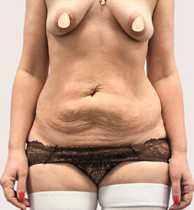 Абдоминопластика - до