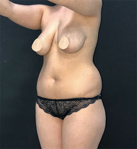 Липосакция - до