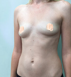 Коррекция асимметрии груди - до