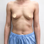 Коррекция асимметрии груди - до