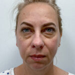 Нижняя блефаропластика - до