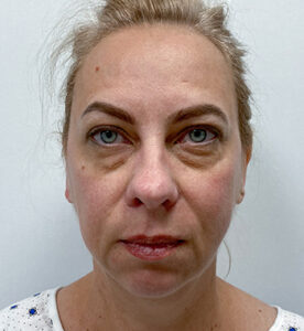 Нижняя блефаропластика - до