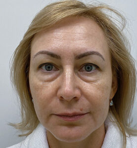 Нижняя блефаропластика - до