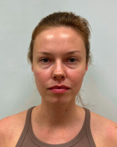 Нижняя блефаропластика - до