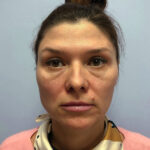 Нижняя блефаропластика - до