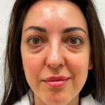 Нижняя блефаропластика - до