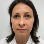 Верхняя блефаропластика - до