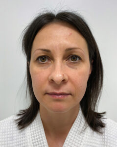 Верхняя блефаропластика - до