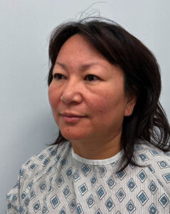 Верхняя блефаропластика - до