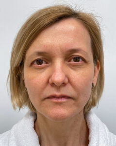 Верхняя блефаропластика - до