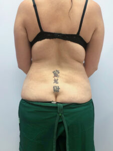 Липосакция - до