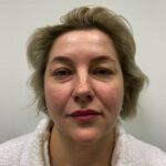 Круговая блефаропластика - до