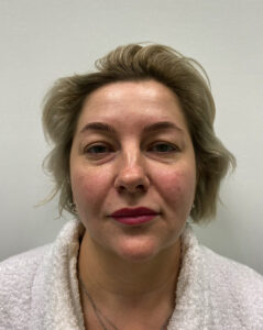 Круговая блефаропластика - до