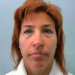 Круговая блефаропластика - до