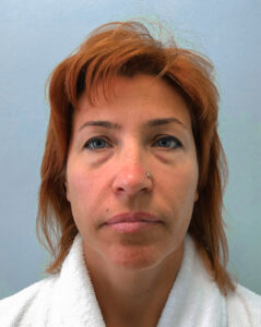 Круговая блефаропластика - до