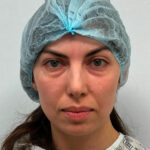 Круговая блефаропластика - до