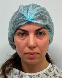 Круговая блефаропластика - до