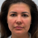 Круговая блефаропластика - до