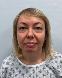 Круговая блефаропластика - до