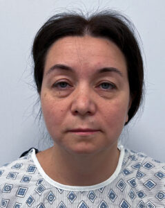 Круговая блефаропластика - до