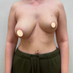 Маммопластика подтяжка - до