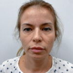 Верхняя блефаропластика - до