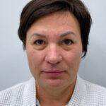 Смас с круговой блефаропластикой - до