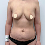 Абдоминопластика - до