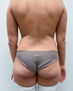 Липосакция - до