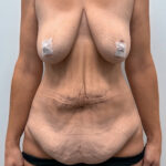 Абдоминопластика - до