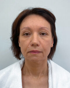 СМАС лифтинг - до